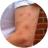 Reações alérgicas